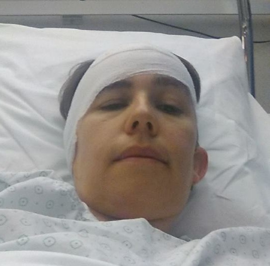 Foto van mijn hoofd vlak na de operatie, met het drukverband.